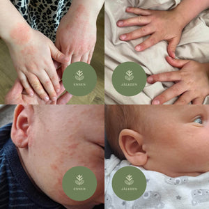 Ennen ja jälkeen kuvia metsäpölyvoiteen tehosta lasten iholla